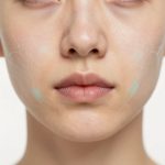 Acne Face Mapping: Linking Breakouts to Internal Health by Facial Zones