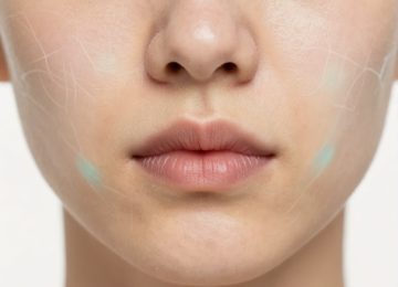 Acne Face Mapping: Linking Breakouts to Internal Health by Facial Zones