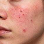 Acne Treatment: Before and After Results and What to Expect