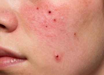 Acne Treatment: Before and After Results and What to Expect