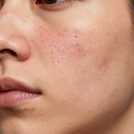 Acne Treatment for Clearer, Smoother Facial Skin