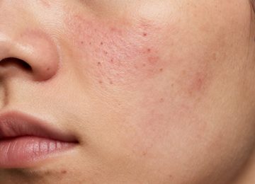 Acne Treatment for Clearer, Smoother Facial Skin