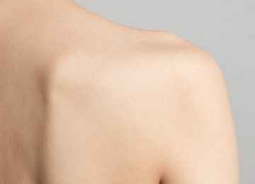 Back Acne Causes, Symptoms, and Effective Treatment Options Explained