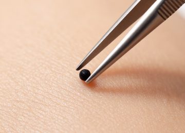 Blackhead Removal Using Fine-Tipped Tweezers: A Precise Technique