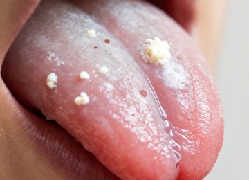 Causes and Significance of a White Coated Tongue in Oral Health