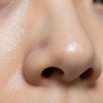 Causes of Blackheads and Pore Congestion Affecting Skin Texture
