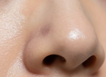 Causes of Blackheads and Pore Congestion Affecting Skin Texture