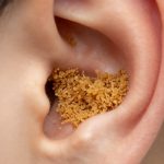 Close-Up View of Significant Earwax Buildup Blocking Ear Canal