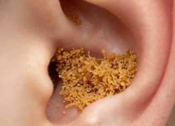 Close-Up View of Significant Earwax Buildup Blocking Ear Canal