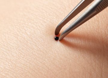 Close-up Skin Blemish Removal Using Tweezers: A Clinical View