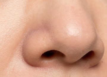 Close-up View of Human Skin Reveals Blackheads and Pores