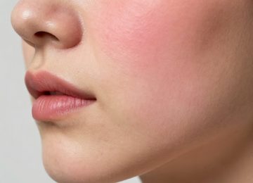 Common Causes of Facial Redness and Skin Inflammation Explained