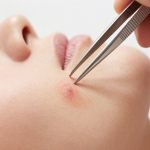 Dangers of Tweezers for Pimple and Blemish Extraction