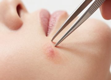 Dangers of Tweezers for Pimple and Blemish Extraction