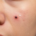 Deep Cleaning Routine for Blackhead and Acne Removal