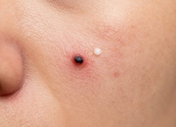 Deep Cleaning Routine for Blackhead and Acne Removal