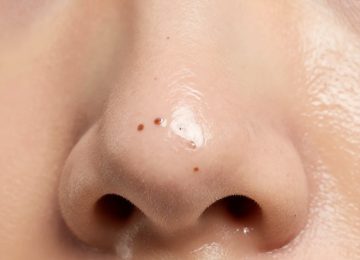 Effective Blackhead Removal Techniques for Acne-Prone Skin