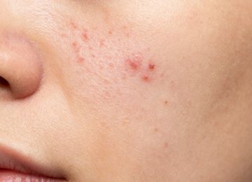 Effective Facial Care for Blackheads, Acne, and Pore Minimization