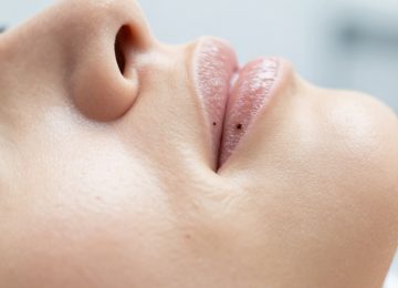 Effective Methods for Managing and Removing Stubborn Blackheads from Pores