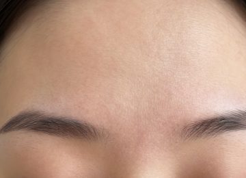 Effective Skincare Strategies for Treating Prominent Red Marks on Forehead