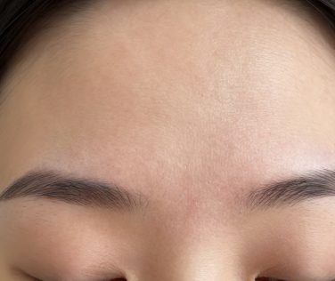Effective Skincare Strategies for Treating Prominent Red Marks on Forehead