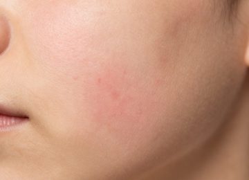 Effective Treatments and Prevention for Razor Burn and Ingrown Hairs