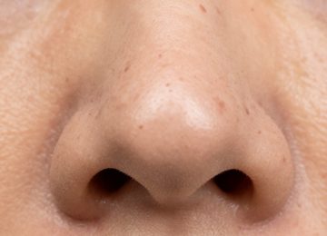 Extreme Close-Up of Enlarged Pores and Blackheads on Human Skin Texture