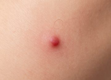 Gentle Home Remedies for Ingrown Hairs and Soothing Skin Irritation