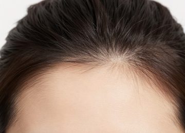 Gently Remove Scalp Flakes and Effectively Treat Dandruff Symptoms
