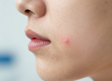 How to Effectively Manage and Treat Active Cystic Acne Breakouts