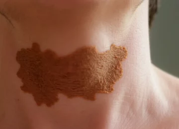 How to Treat Hyperpigmentation and Blackheads on Your Neck