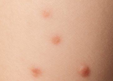 Identifying Irregular Skin Growths and Lesions: A Visual Guide