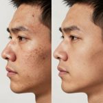 Male Acne Skincare Transformation: Before and After Results for Adults
