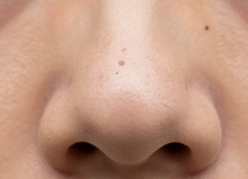 Managing Visible Pores and Blackheads on Nose Skin Texture