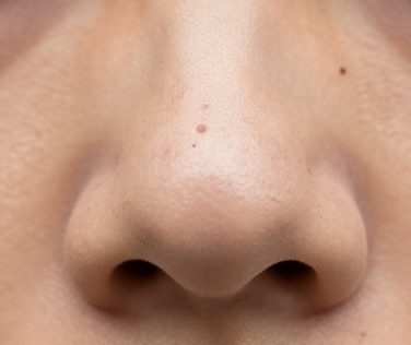 Managing Visible Pores and Blackheads on Nose Skin Texture