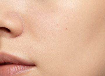 Pore Minimizing Skin Treatment Results for Facial Skin