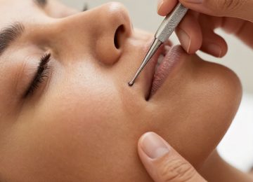 Professional Blackhead Extraction on Brown Skin: A Closer Look