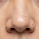 Professional Blackhead Removal Treatment for Nose Blackheads