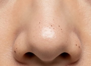 Professional Blackhead Removal Treatment for Nose Blackheads