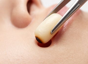 Professional Extraction of a Large Solid Skin Plug Using Metal Tweezers