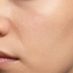 Realistic Close-Up of Acne-Prone Skin Texture and Visible Pores