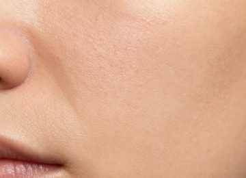 Realistic Close-Up of Acne-Prone Skin Texture and Visible Pores