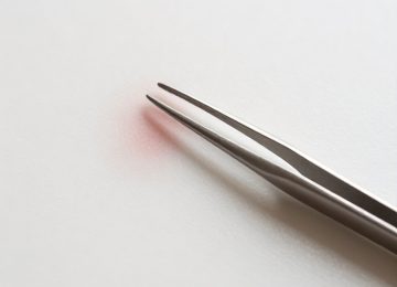 Safely Removing Splinters and Skin Irritations Using Tweezers