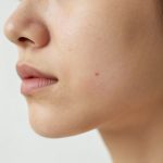 Skincare Solutions for Inflamed Jawline Acne Treatment