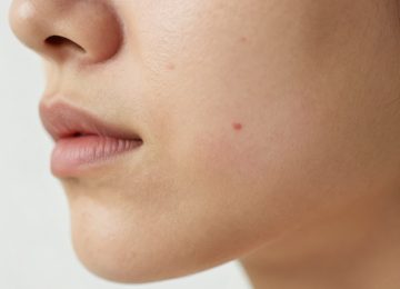 Skincare Solutions for Inflamed Jawline Acne Treatment