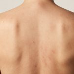 Solutions for Inflamed Skin on the Back: Causes and Treatments