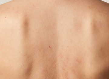 Solutions for Inflamed Skin on the Back: Causes and Treatments