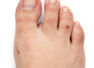 Types of Skin Growths and Lesions Found on the Foot Sole