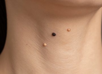 Understanding Benign Skin Growths and Bumps on Your Neck