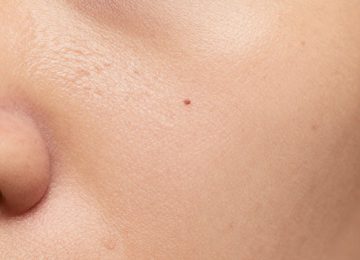 Understanding Blackheads and Clogged Pores on Forehead Skin